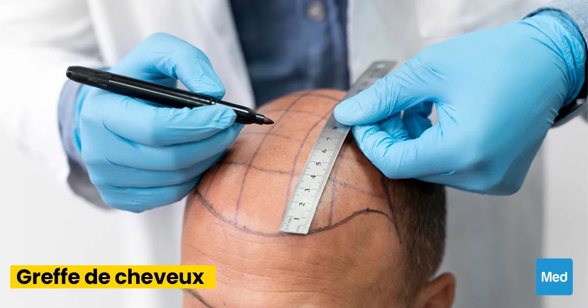 La Greffe de Cheveux : Restaurer la Beauté Naturelle et la Confiance en Soi